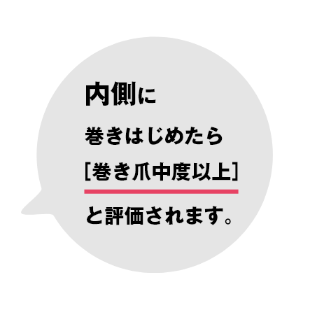 内側に巻き始めたら巻き爪中度以上と評価されます。