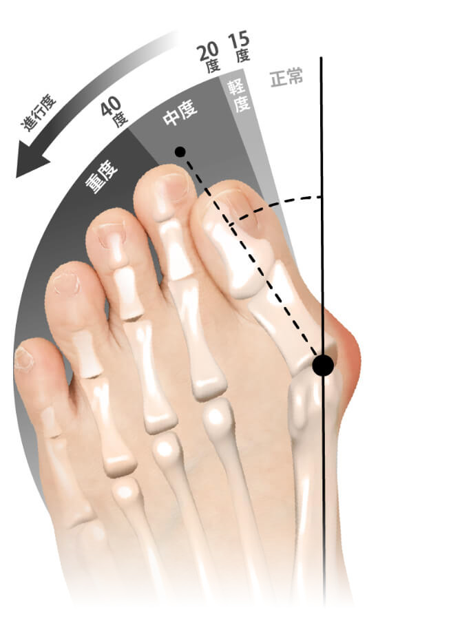 外反母趾とは