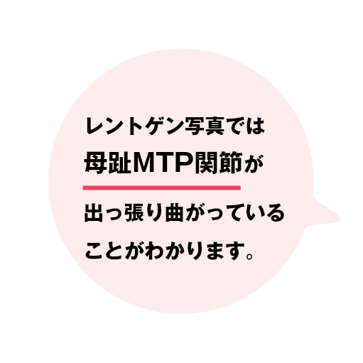 レントゲン写真では母趾MTP関節が出っ張り曲がっていることがわかります。