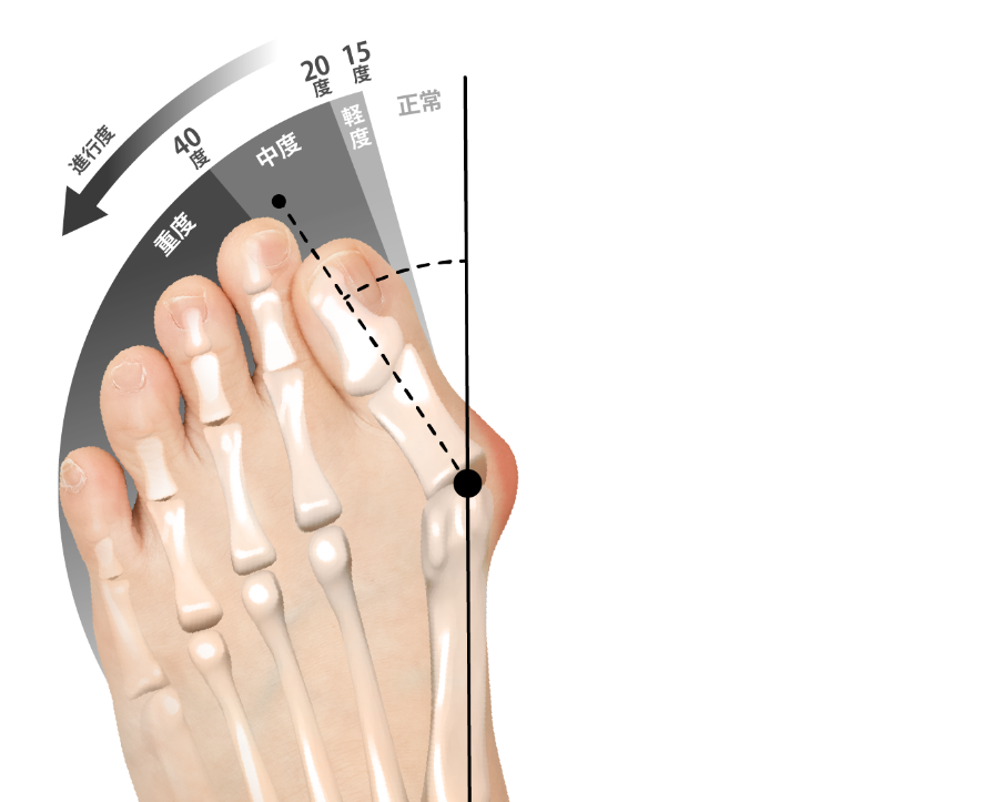 外反母趾の角度と曲がり具合