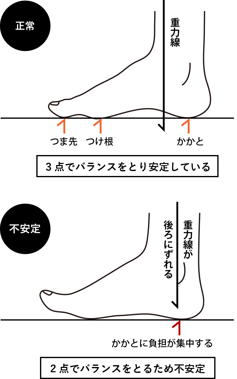 アーチ構造の崩れが及ぼす悪影響