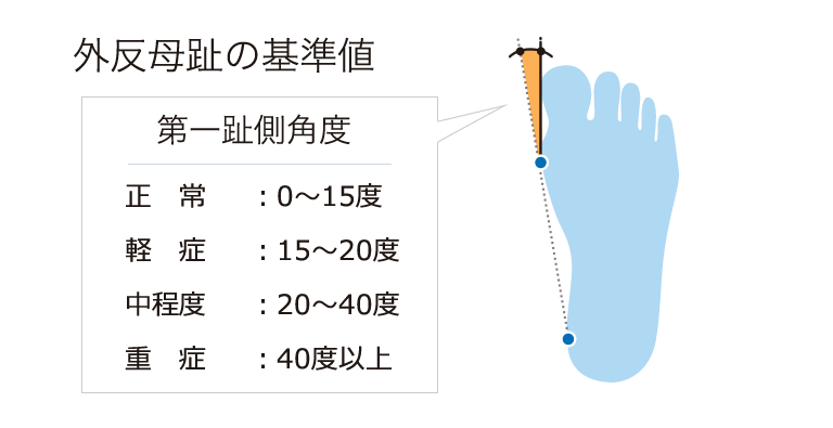 第五趾
