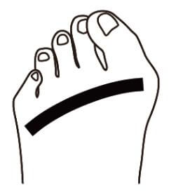 靭帯性外反母趾（図）