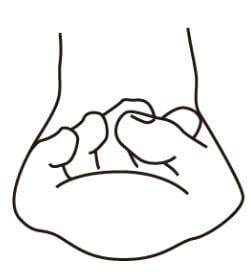 病変性外反母趾（図）