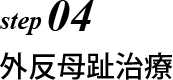 外反母趾治療