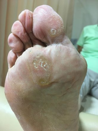 70代女性施術前