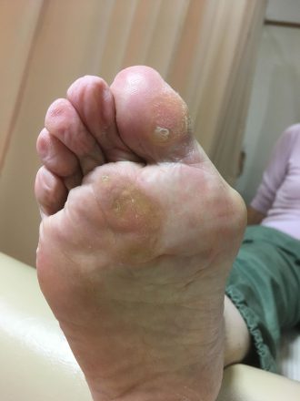 70代女性3ヶ月後