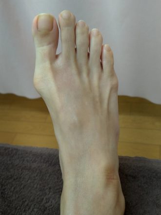 50代女性施術後