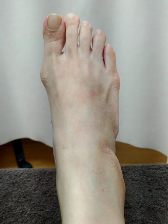 50代女性施術前