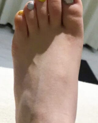 20代女性（目黒区）施術前