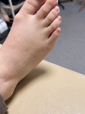 40代女性（京都市）施術前