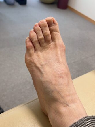 60代女性（京都市）施術前