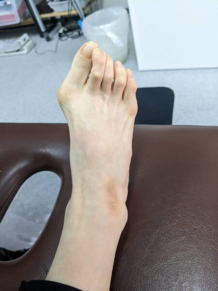 60代女性（大阪市からお越しの方）施術前