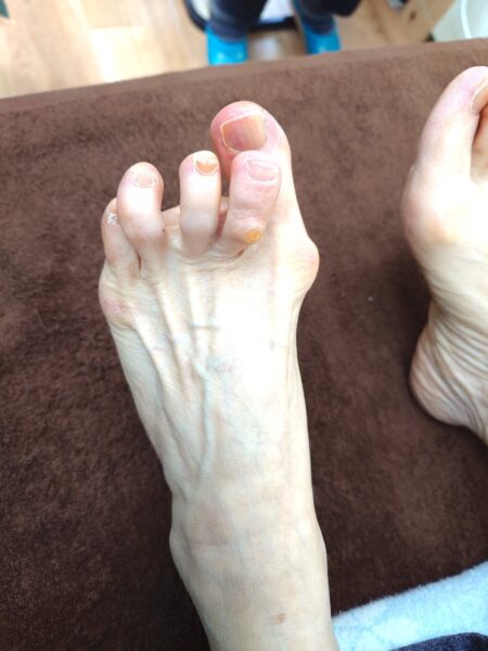 80歳女性（徳島市からお越しの方）施術前