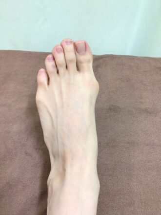 40代女性(葛飾区)施術前