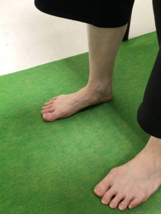 30代女性(大宮市)施術後