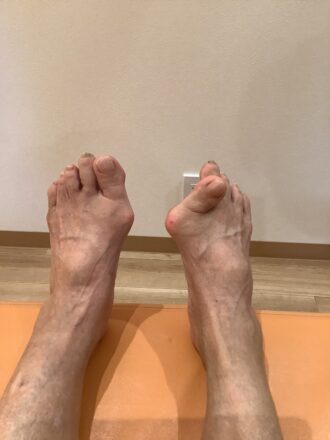 70歳代女性（岡崎市）施術前