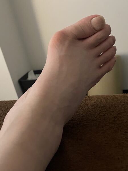 60代女性（日本橋からお越しの方）施術前
