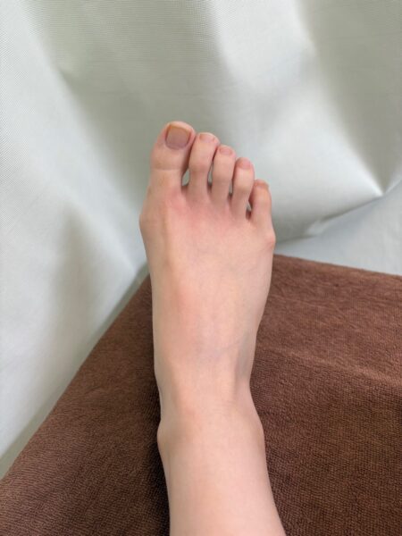 20代女性（柳川市からお越しの方）施術前