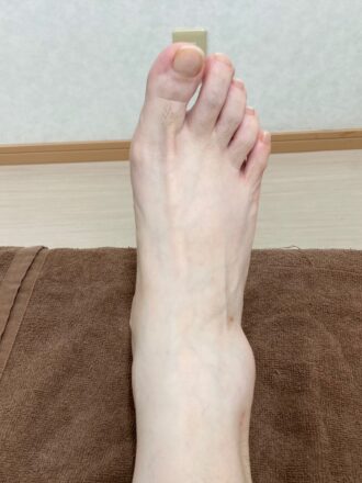50代女性（筑紫野市）施術前