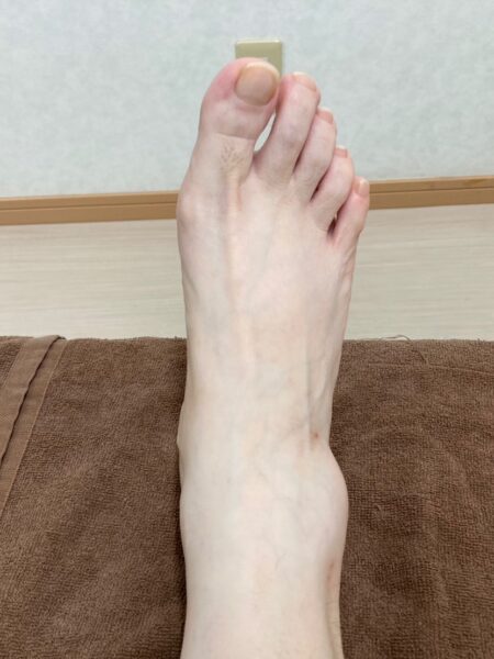50代女性（筑紫野市からお越しの方）施術前
