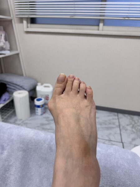 50代女性（江東区からお越しの方）施術前