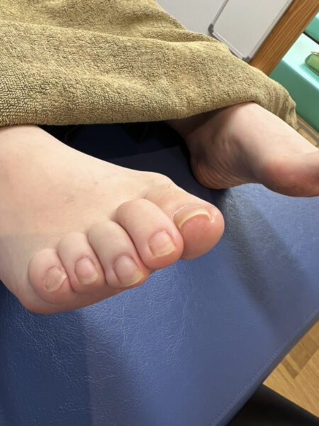 20代女性（練馬区からお越しの方）施術前