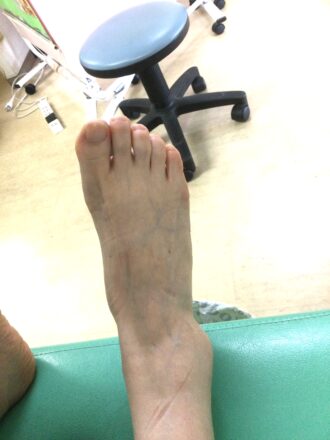 40代女性(日野市)施術前