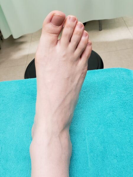 30代女性（大阪市からお越しの方）施術前