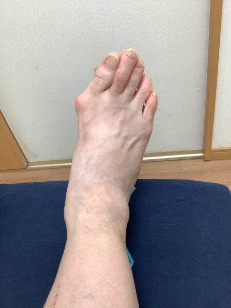 60代女性（西尾市からお越しの方）施術前