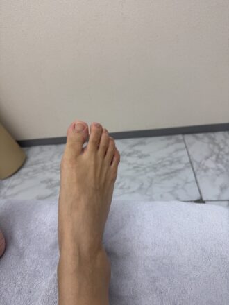 40代女性（墨田区）施術前