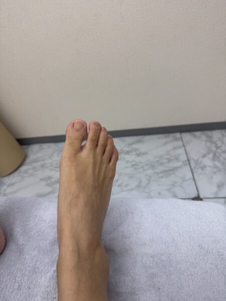 40代女性（墨田区からお越しの方）施術前