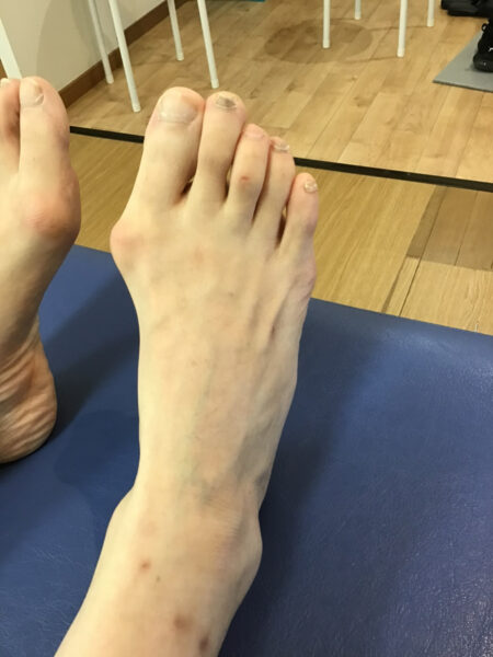 50代女性（練馬区からお越しの方）施術前