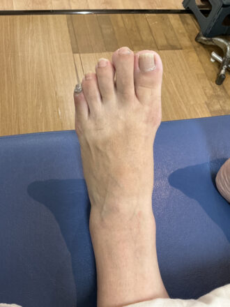 50代女性（練馬区）施術前