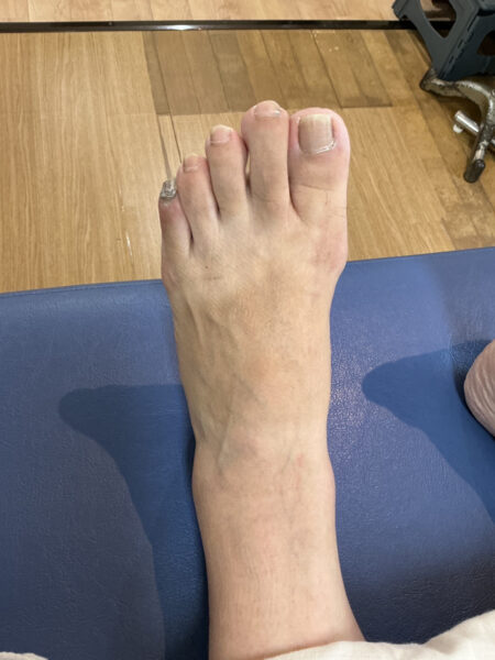 50代女性（練馬区からお越しの方）施術前