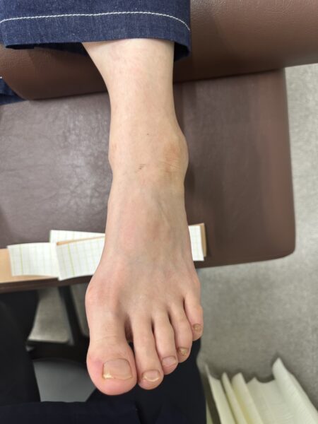 50代女性（大阪市からお越しの方）施術前
