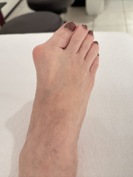 70代女性（千代田区からお越しの方）施術前