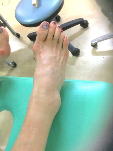 50代女性（日野市からお越しの方）施術前