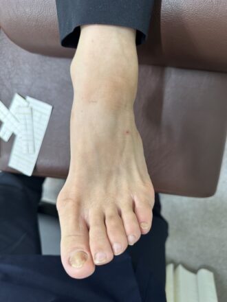 50代女性（京都市）施術前