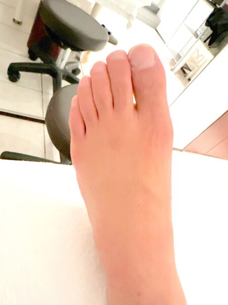 40代男性（千代田区からお越しの方）施術前