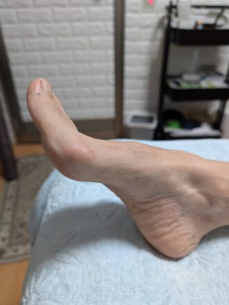 50代女性(高崎市)施術前