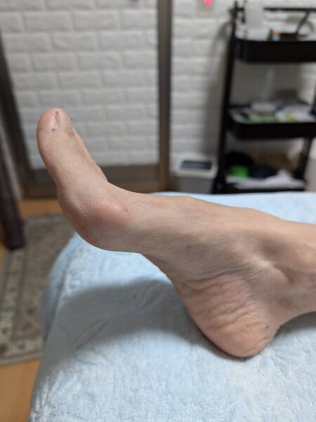 50代女性(高崎市からお越しの方)施術前