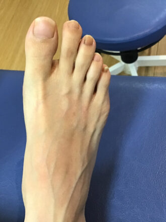 50代女性（練馬区）施術前
