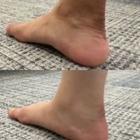 【距骨サロン日本橋店】症例紹介『扁平足』