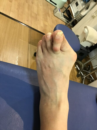 60代男性（練馬区）施術前