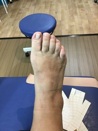 50代女性（練馬区）施術前