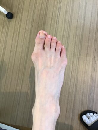 50代女性（練馬区）施術前