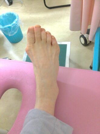 60代女性（日野市）施術前