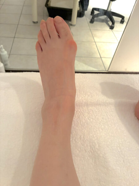 50代女性（千代田区からお越しの方）施術前