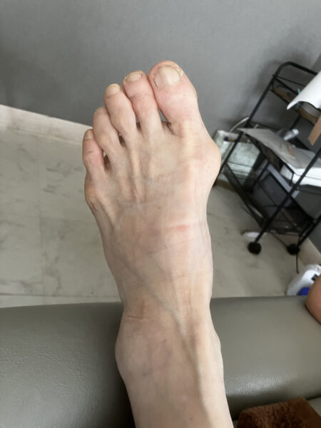 70代女性（小平市からお越しの方）施術前